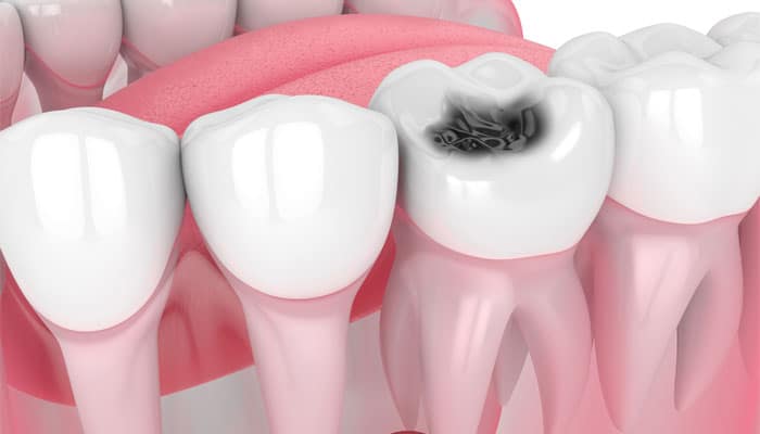 🦷 Tratamentul cariilor